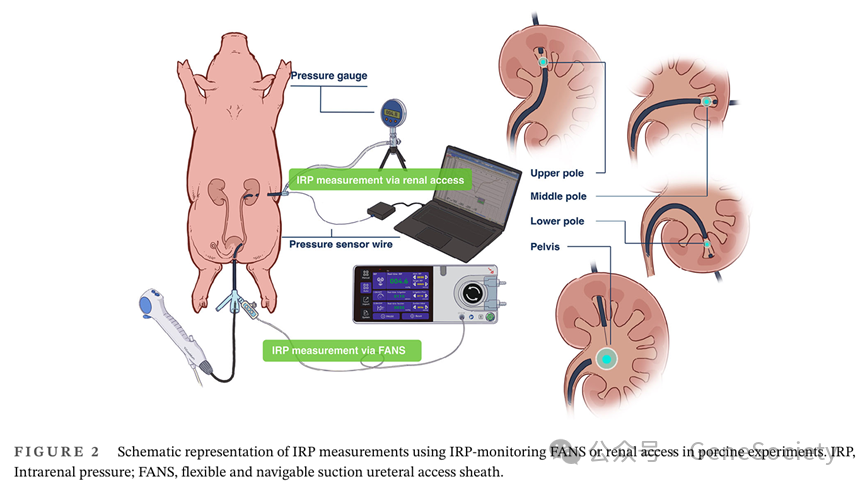 输尿管鞘是什么CTD期刊 ｜ 新突破！实时监测肾内压，新型输尿管鞘让肾结石手术更高效、更安全_https://www.jmylbn.com_新闻资讯_第3张