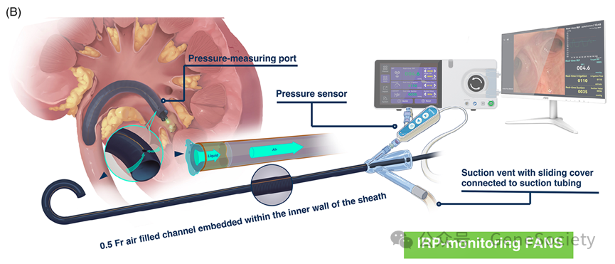 输尿管鞘是什么CTD期刊 ｜ 新突破！实时监测肾内压，新型输尿管鞘让肾结石手术更高效、更安全_https://www.jmylbn.com_新闻资讯_第5张