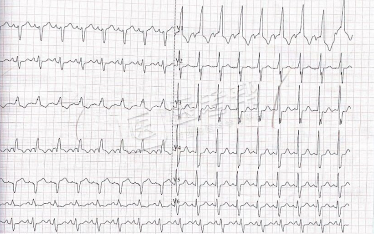 Med怎么电写今年技能基地考试有这些变化，技能考试心电图部分知识点你都会吗？_https://www.jmylbn.com_新闻资讯_第17张