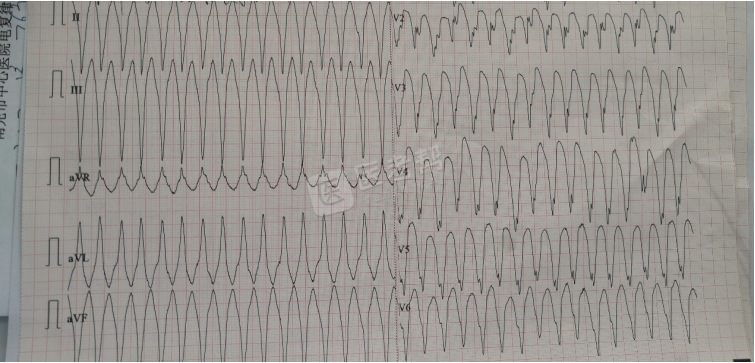 Med怎么电写今年技能基地考试有这些变化，技能考试心电图部分知识点你都会吗？_https://www.jmylbn.com_新闻资讯_第8张