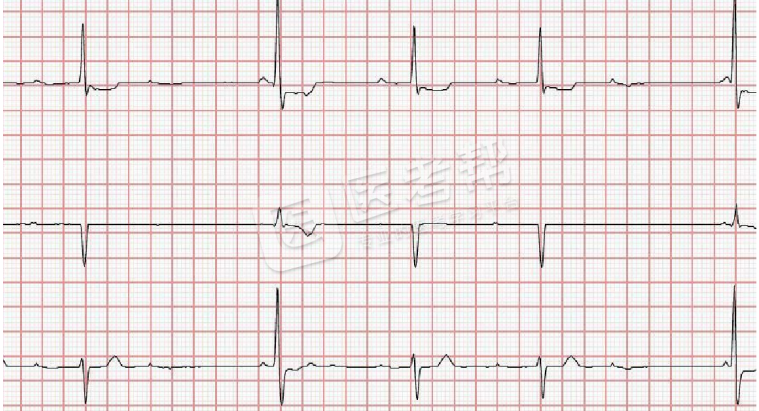Med怎么电写今年技能基地考试有这些变化，技能考试心电图部分知识点你都会吗？_https://www.jmylbn.com_新闻资讯_第11张