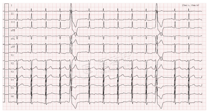 Med怎么电写今年技能基地考试有这些变化，技能考试心电图部分知识点你都会吗？_https://www.jmylbn.com_新闻资讯_第7张