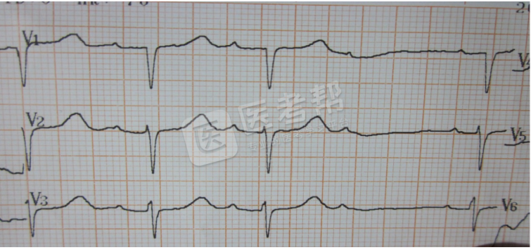 Med怎么电写今年技能基地考试有这些变化，技能考试心电图部分知识点你都会吗？_https://www.jmylbn.com_新闻资讯_第12张