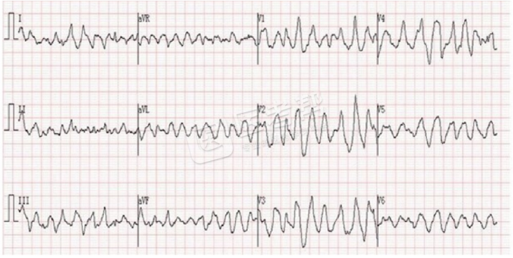 Med怎么电写今年技能基地考试有这些变化，技能考试心电图部分知识点你都会吗？_https://www.jmylbn.com_新闻资讯_第9张