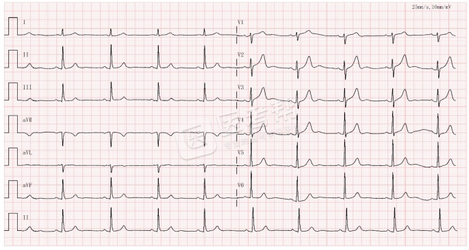 Med怎么电写今年技能基地考试有这些变化，技能考试心电图部分知识点你都会吗？_https://www.jmylbn.com_新闻资讯_第2张