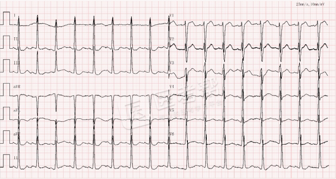 Med怎么电写今年技能基地考试有这些变化，技能考试心电图部分知识点你都会吗？_https://www.jmylbn.com_新闻资讯_第16张