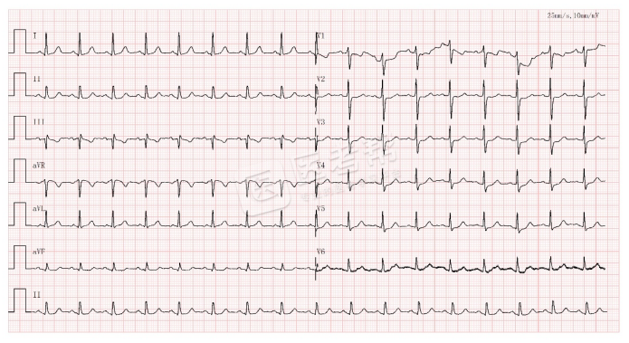 Med怎么电写今年技能基地考试有这些变化，技能考试心电图部分知识点你都会吗？_https://www.jmylbn.com_新闻资讯_第3张