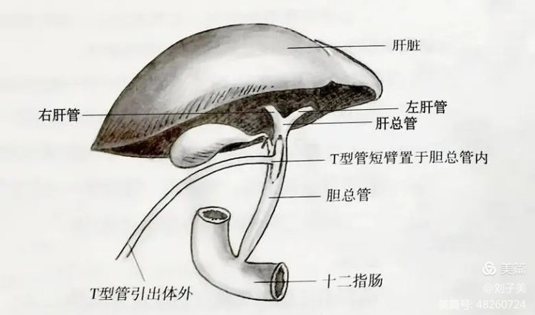 引流袋管子怎么不流病痛一“管”到底—“T管”的居家护理_https://www.jmylbn.com_新闻资讯_第2张