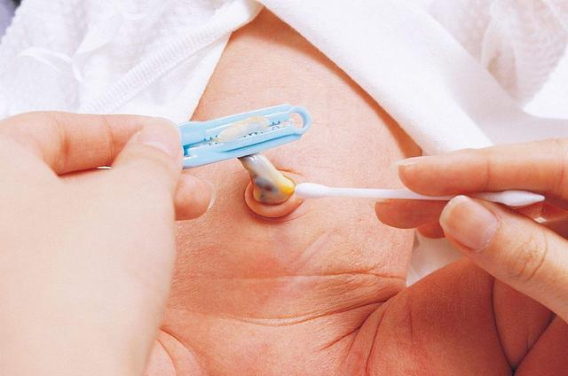 新生儿肚脐夹怎么打开新生儿宝宝的脐带什么时候脱落？肚脐的日常消毒怎么做？_https://www.jmylbn.com_新闻资讯_第5张