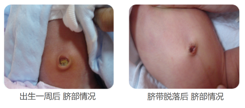 新生儿肚脐夹怎么打开新生儿宝宝的脐带什么时候脱落？肚脐的日常消毒怎么做？_https://www.jmylbn.com_新闻资讯_第4张