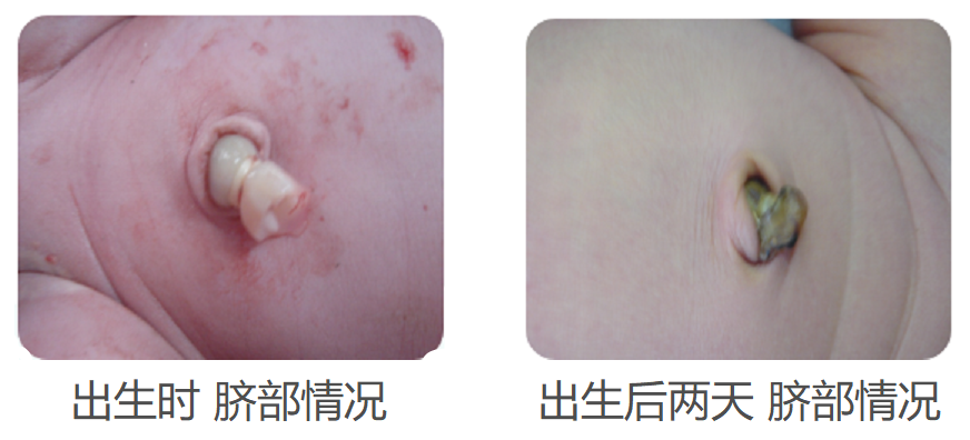 新生儿肚脐夹怎么打开新生儿宝宝的脐带什么时候脱落？肚脐的日常消毒怎么做？_https://www.jmylbn.com_新闻资讯_第3张