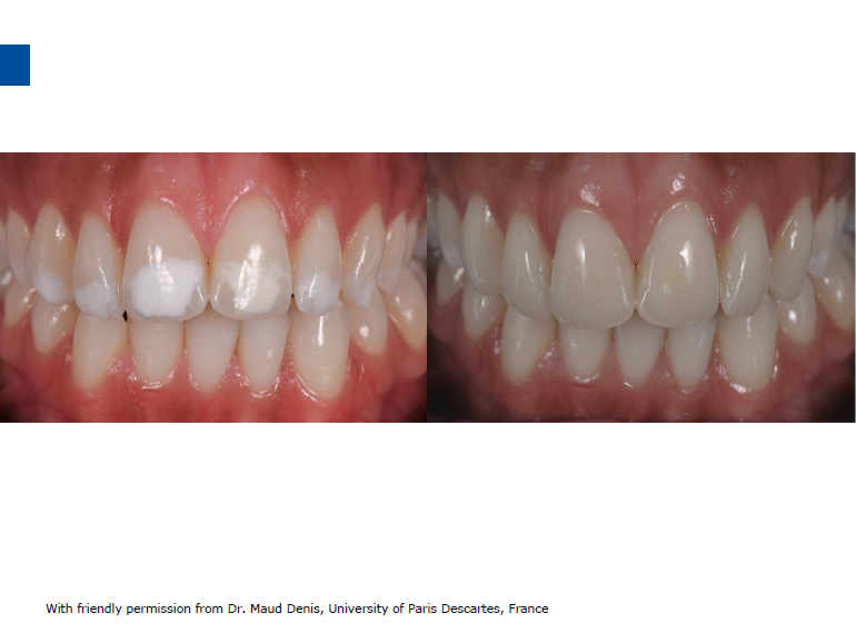dmg口腔材料怎么使用德国DMG  Icon 渗透树脂，应该这样用……_https://www.jmylbn.com_新闻资讯_第72张