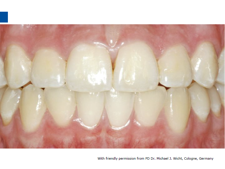 dmg口腔材料怎么使用德国DMG  Icon 渗透树脂，应该这样用……_https://www.jmylbn.com_新闻资讯_第17张