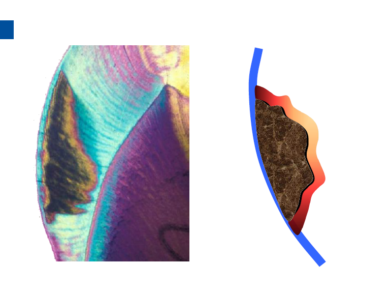 dmg口腔材料怎么使用德国DMG  Icon 渗透树脂，应该这样用……_https://www.jmylbn.com_新闻资讯_第42张