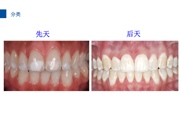 dmg口腔材料怎么使用德国DMG  Icon 渗透树脂，应该这样用……_https://www.jmylbn.com_新闻资讯_第14张