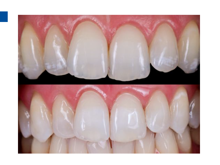 dmg口腔材料怎么使用德国DMG  Icon 渗透树脂，应该这样用……_https://www.jmylbn.com_新闻资讯_第64张