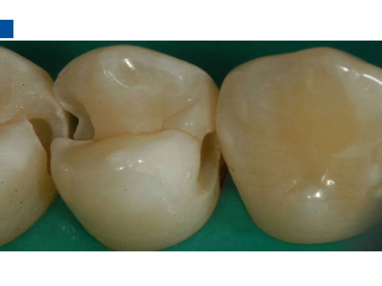 dmg口腔材料怎么使用德国DMG  Icon 渗透树脂，应该这样用……_https://www.jmylbn.com_新闻资讯_第25张