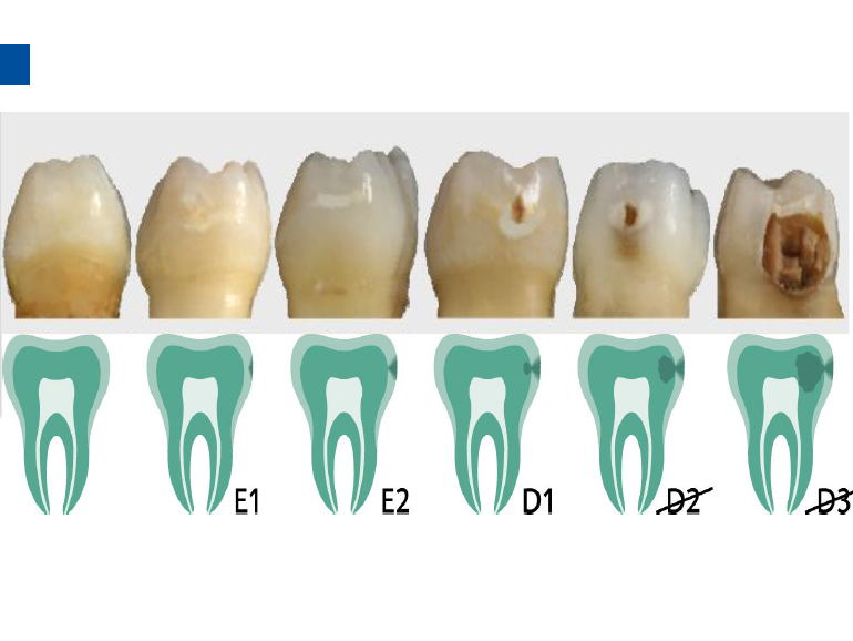 dmg口腔材料怎么使用德国DMG  Icon 渗透树脂，应该这样用……_https://www.jmylbn.com_新闻资讯_第22张
