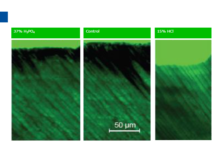 dmg口腔材料怎么使用德国DMG  Icon 渗透树脂，应该这样用……_https://www.jmylbn.com_新闻资讯_第41张