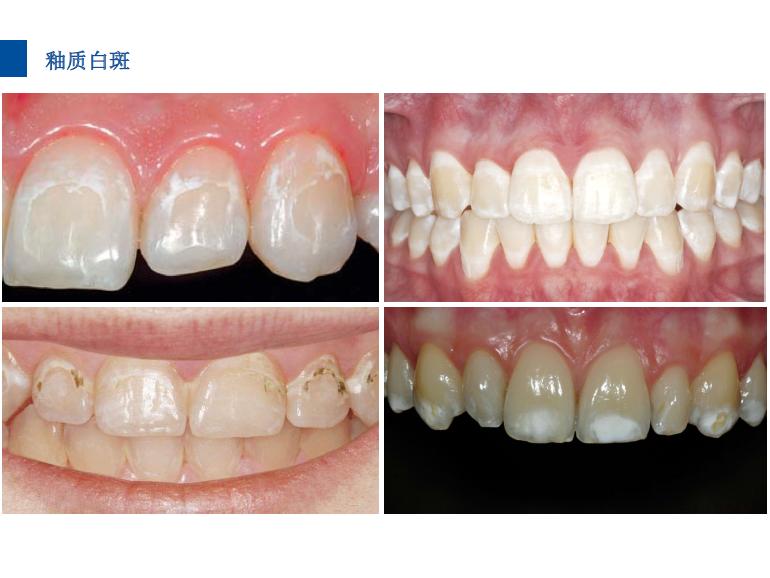 dmg口腔材料怎么使用德国DMG  Icon 渗透树脂，应该这样用……_https://www.jmylbn.com_新闻资讯_第12张