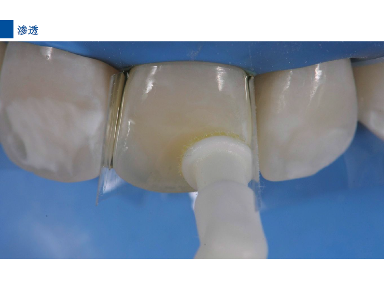 dmg口腔材料怎么使用德国DMG  Icon 渗透树脂，应该这样用……_https://www.jmylbn.com_新闻资讯_第70张