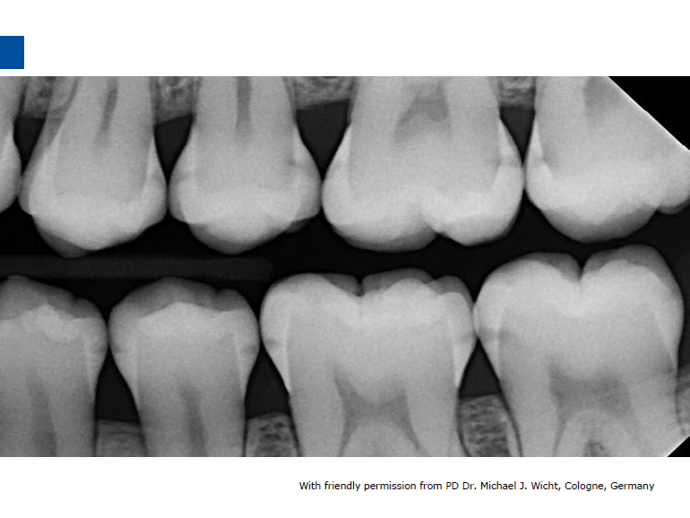 dmg口腔材料怎么使用德国DMG  Icon 渗透树脂，应该这样用……_https://www.jmylbn.com_新闻资讯_第21张