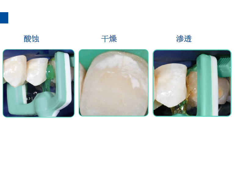 dmg口腔材料怎么使用德国DMG  Icon 渗透树脂，应该这样用……_https://www.jmylbn.com_新闻资讯_第39张