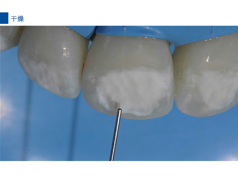 dmg口腔材料怎么使用德国DMG  Icon 渗透树脂，应该这样用……_https://www.jmylbn.com_新闻资讯_第69张