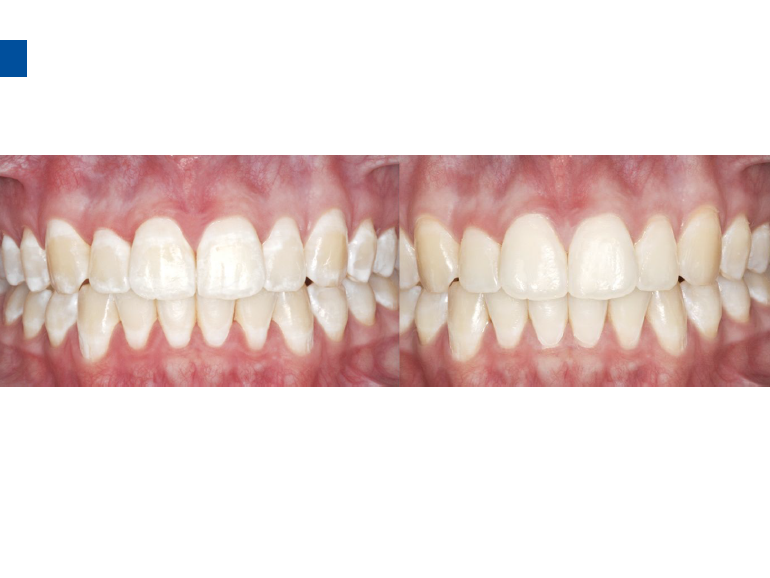 dmg口腔材料怎么使用德国DMG  Icon 渗透树脂，应该这样用……_https://www.jmylbn.com_新闻资讯_第79张