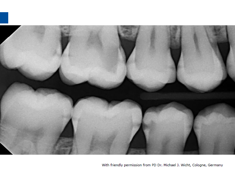 dmg口腔材料怎么使用德国DMG  Icon 渗透树脂，应该这样用……_https://www.jmylbn.com_新闻资讯_第20张