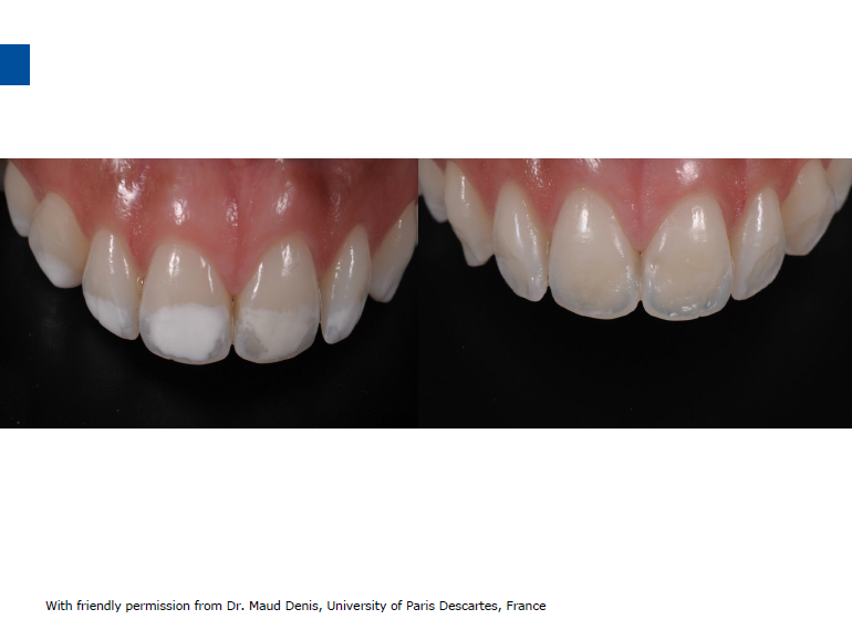 dmg口腔材料怎么使用德国DMG  Icon 渗透树脂，应该这样用……_https://www.jmylbn.com_新闻资讯_第71张
