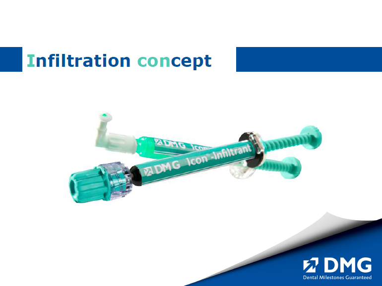 dmg口腔材料怎么使用德国DMG  Icon 渗透树脂，应该这样用……_https://www.jmylbn.com_新闻资讯_第11张