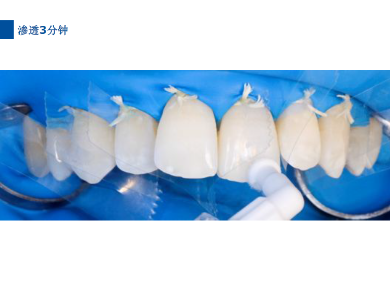 dmg口腔材料怎么使用德国DMG  Icon 渗透树脂，应该这样用……_https://www.jmylbn.com_新闻资讯_第59张