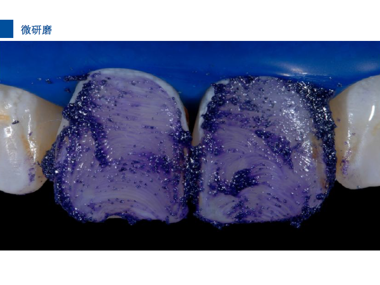 dmg口腔材料怎么使用德国DMG  Icon 渗透树脂，应该这样用……_https://www.jmylbn.com_新闻资讯_第28张