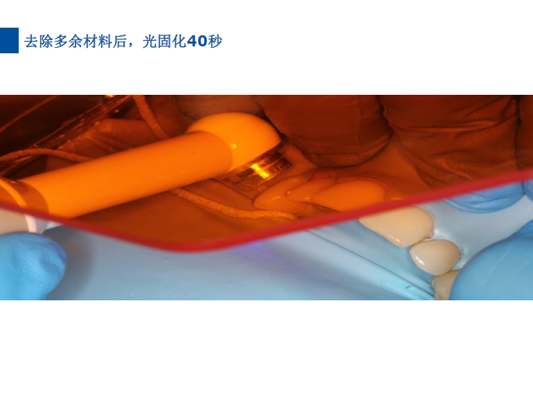 dmg口腔材料怎么使用德国DMG  Icon 渗透树脂，应该这样用……_https://www.jmylbn.com_新闻资讯_第60张
