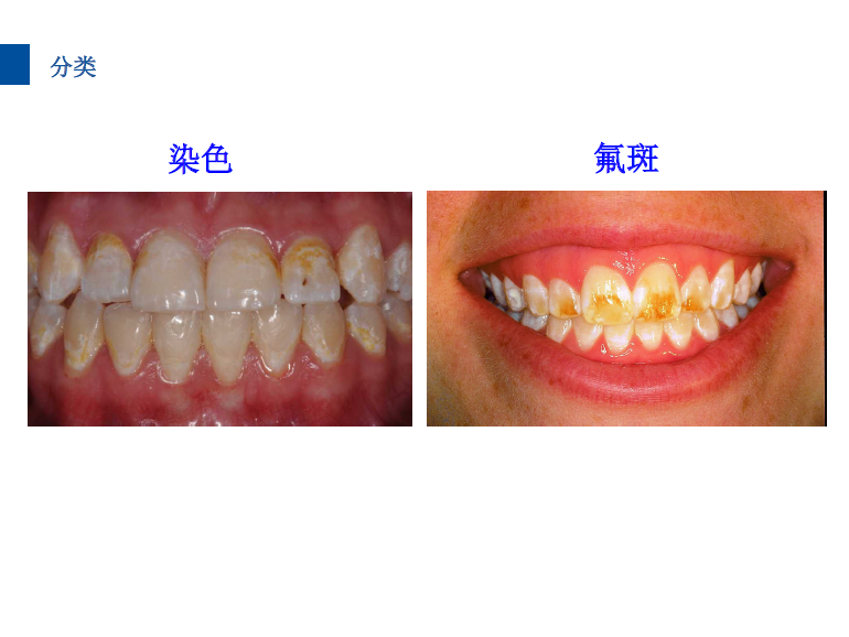 dmg口腔材料怎么使用德国DMG  Icon 渗透树脂，应该这样用……_https://www.jmylbn.com_新闻资讯_第15张