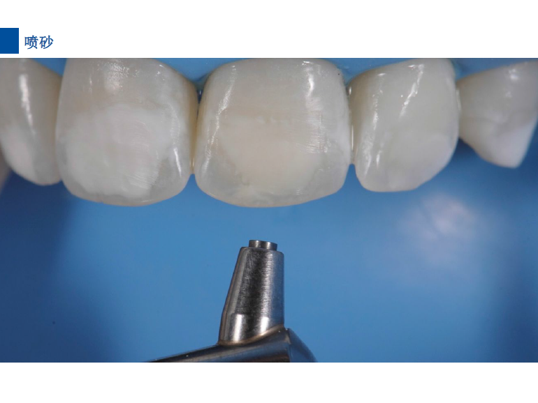 dmg口腔材料怎么使用德国DMG  Icon 渗透树脂，应该这样用……_https://www.jmylbn.com_新闻资讯_第67张