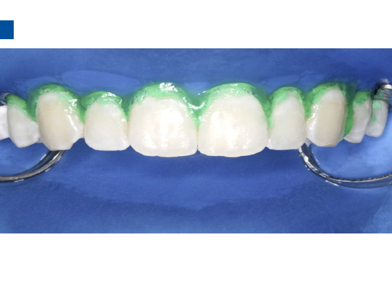 dmg口腔材料怎么使用德国DMG  Icon 渗透树脂，应该这样用……_https://www.jmylbn.com_新闻资讯_第78张