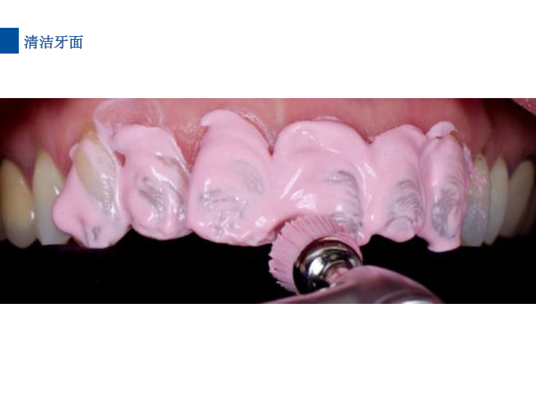 dmg口腔材料怎么使用德国DMG  Icon 渗透树脂，应该这样用……_https://www.jmylbn.com_新闻资讯_第53张