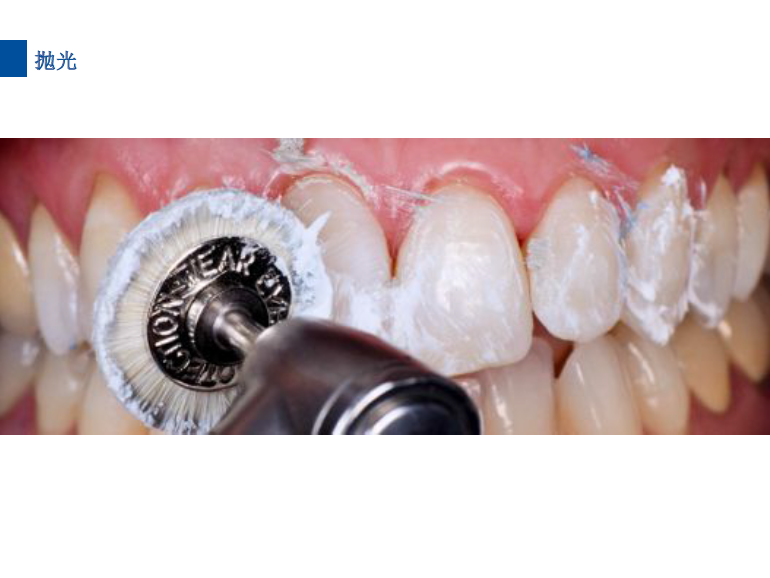 dmg口腔材料怎么使用德国DMG  Icon 渗透树脂，应该这样用……_https://www.jmylbn.com_新闻资讯_第62张