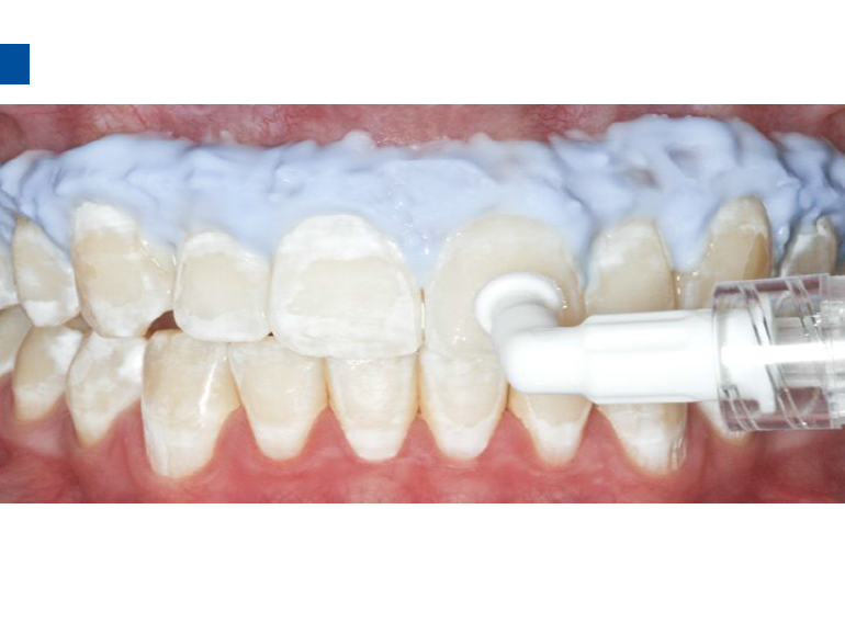 dmg口腔材料怎么使用德国DMG  Icon 渗透树脂，应该这样用……_https://www.jmylbn.com_新闻资讯_第75张