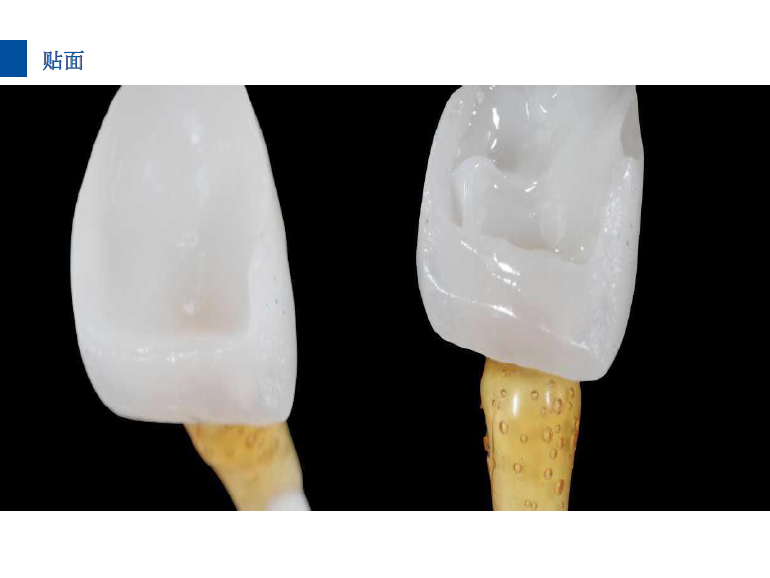 dmg口腔材料怎么使用德国DMG  Icon 渗透树脂，应该这样用……_https://www.jmylbn.com_新闻资讯_第29张