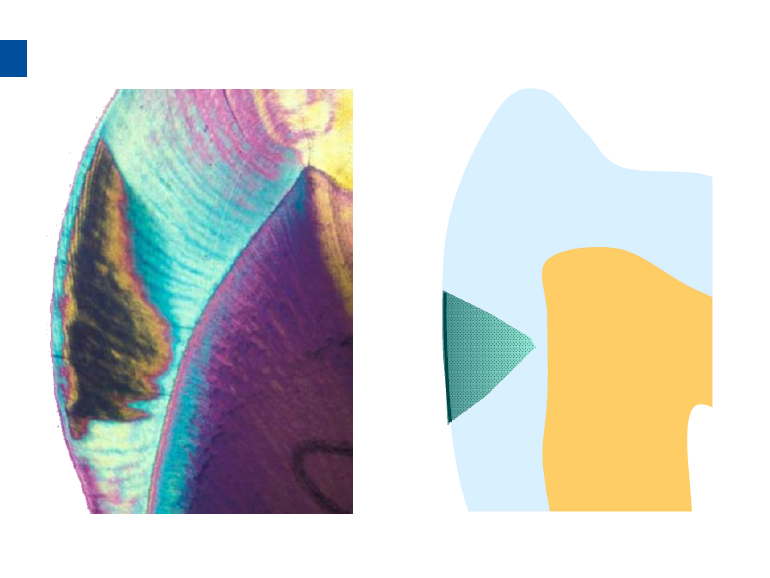 dmg口腔材料怎么使用德国DMG  Icon 渗透树脂，应该这样用……_https://www.jmylbn.com_新闻资讯_第33张