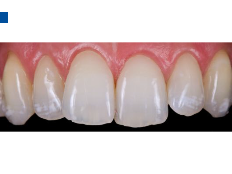 dmg口腔材料怎么使用德国DMG  Icon 渗透树脂，应该这样用……_https://www.jmylbn.com_新闻资讯_第52张