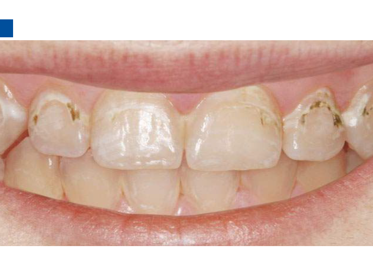 dmg口腔材料怎么使用德国DMG  Icon 渗透树脂，应该这样用……_https://www.jmylbn.com_新闻资讯_第27张