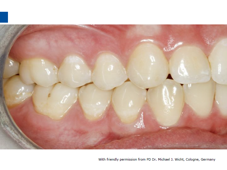 dmg口腔材料怎么使用德国DMG  Icon 渗透树脂，应该这样用……_https://www.jmylbn.com_新闻资讯_第18张