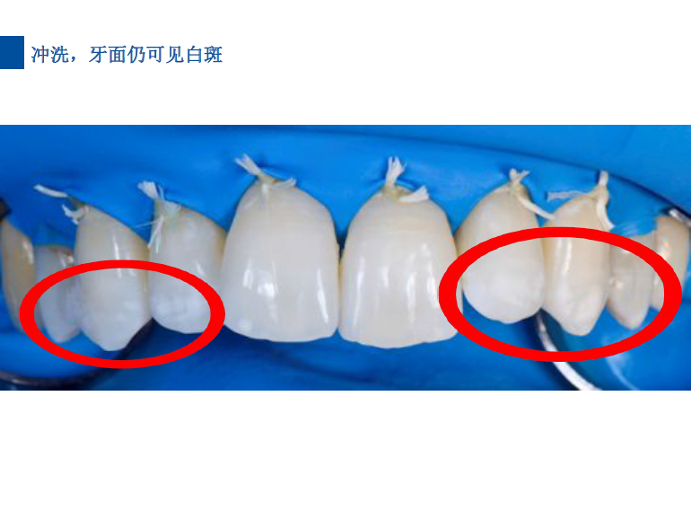 dmg口腔材料怎么使用德国DMG  Icon 渗透树脂，应该这样用……_https://www.jmylbn.com_新闻资讯_第55张