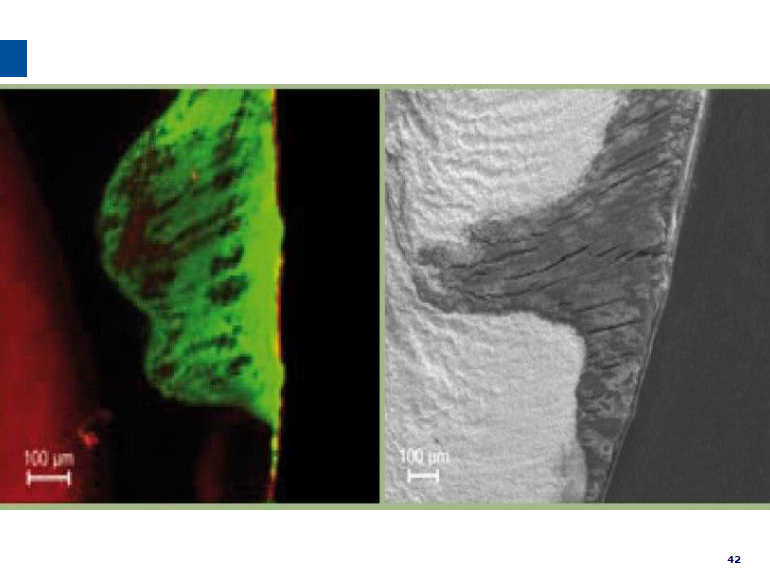 dmg口腔材料怎么使用德国DMG  Icon 渗透树脂，应该这样用……_https://www.jmylbn.com_新闻资讯_第43张