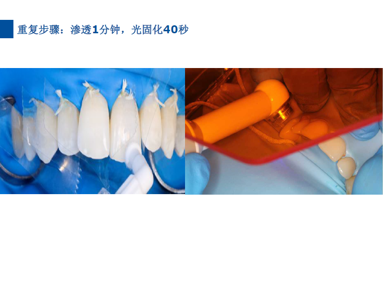 dmg口腔材料怎么使用德国DMG  Icon 渗透树脂，应该这样用……_https://www.jmylbn.com_新闻资讯_第61张