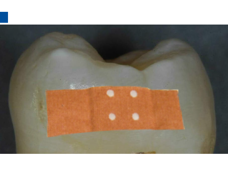 dmg口腔材料怎么使用德国DMG  Icon 渗透树脂，应该这样用……_https://www.jmylbn.com_新闻资讯_第23张